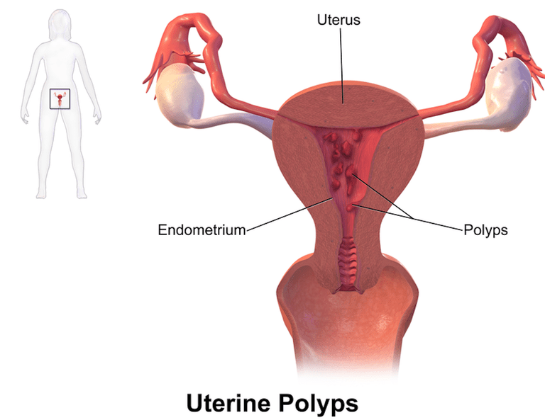 polipów macicy, macicy jest, kobiet doświadcza, którym radiolog, objawy polipów