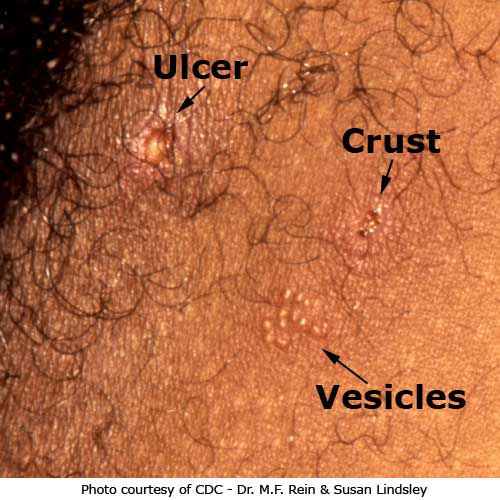 narządów płciowych, jamie ustnej, wirusem opryszczki, ospy wietrznej, opryszczki narządów, opryszczki narządów płciowych
