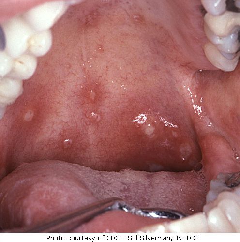 narządów płciowych, jamie ustnej, wirusem opryszczki, ospy wietrznej, opryszczki narządów, opryszczki narządów płciowych