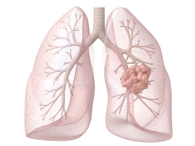 raka płuc, raka płuca, objawy raka, objawy raka płuc, osób niepalących