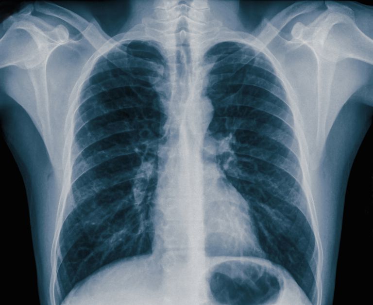 klatki piersiowej, odmy opłucnowej, Odma opłucnowa, jest Pneumothorax
