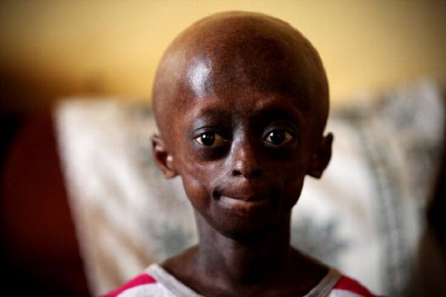 Zespół Wernera, dzieci progerią, progeria jest, szybkie starzenie, tkanki tłuszczowej, Wernera występuje